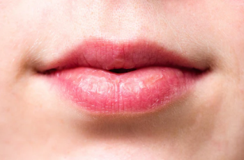 Dry Skin Around the Mouth: Causes, Prevention Tips, and Effective Treatments for Relief