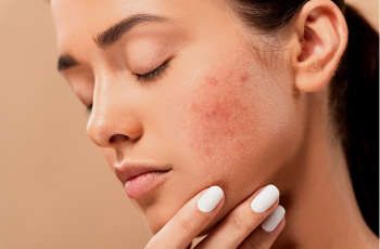 How to Get Rid of Acne: 8 Natural Treatments for Pimples