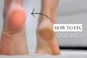 How to Transform Cracked Heels for Sandal Season | Exfoliating Foot Treatment
