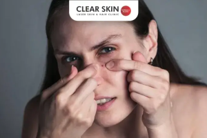 How to Get Rid of Pimples Effectively: Clear Skin Tips Backed by Science