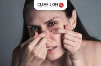 How to Get Rid of Pimples Effectively: Clear Skin Tips Backed by Science