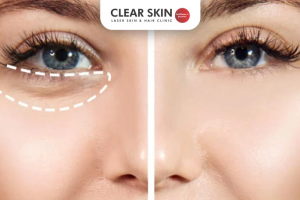 How to Get Rid of Bags Under Your Eyes: Causes, Remedies & Expert Tips