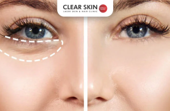 How to Get Rid of Bags Under Your Eyes: Causes, Remedies & Expert Tips