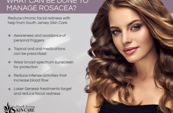Expert Guide to Managing Rosacea: Treatment & Prevention