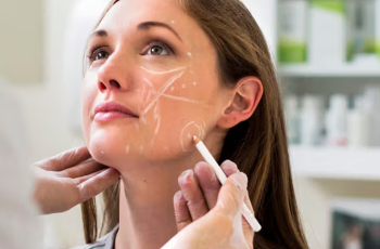 Filler for Acne Scars: Everything to Know About the Minimally Invasive Treatment Filler for Acne Scars: Everything to Know About the Minimally Invasive Treatment