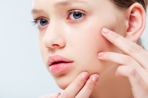 Acne Management: Clinical Strategies for Clearer Skin