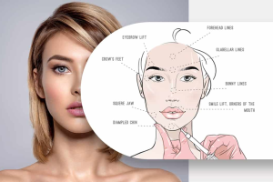 Treatment Approaches for Deep Wrinkles Around the Mouth